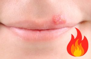 ¿Fogazos? Combátelos siguiendo estos 6 maravillosos consejos