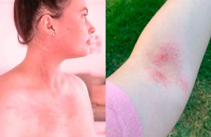 ¿Alergia al agua? Si, existe y una joven de 22 años la padece